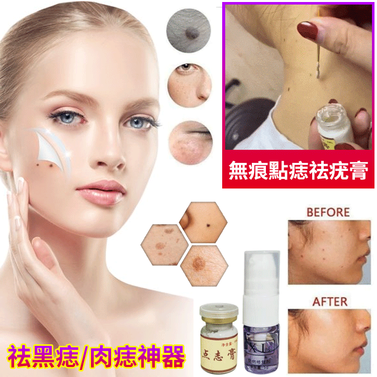 【點痣套裝】點痣膏+修復液 無痕去痣痦子去瘊子扁平尤絲狀尤尖尤肉刺肉粒